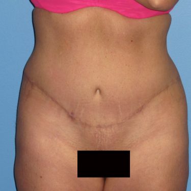 Tummy Tuck After Patient 8