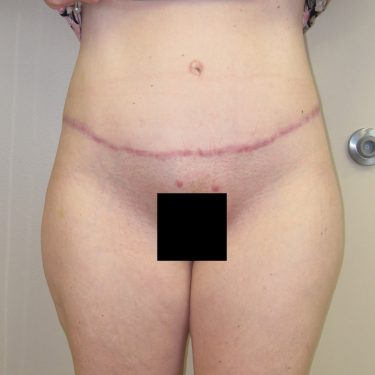 Tummy Tuck After Patient 7
