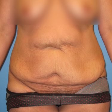 Tummy Tuck Before Patient 6