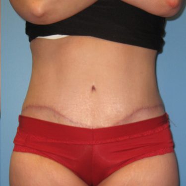 Tummy Tuck After Patient 6