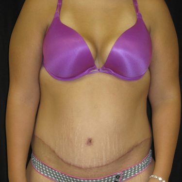 Tummy Tuck After Patient 5