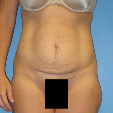 Tummy Tuck Before Patient 4