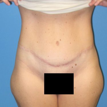 Tummy Tuck After Patient 4