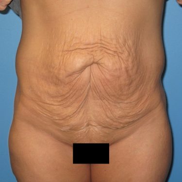 Tummy Tuck Before Patient 3