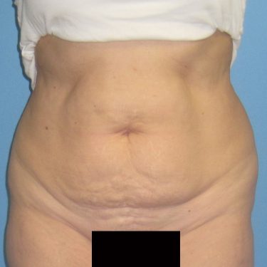 Tummy Tuck Before Patient 2