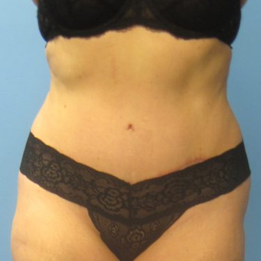 Tummy Tuck After Patient 2