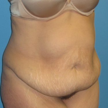 Tummy Tuck Before Patient 1