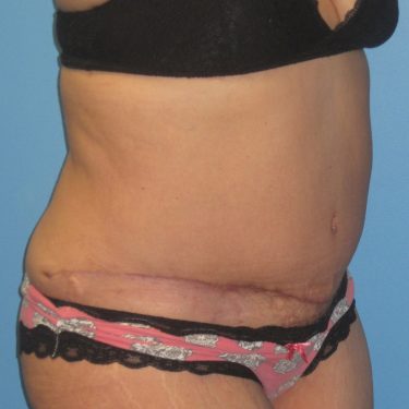 Tummy Tuck After Patient 1