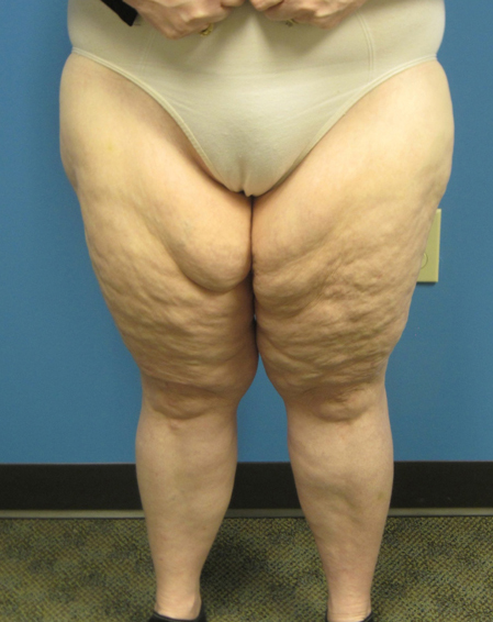 Thigh Lift Before Patient 1