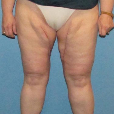 Thigh Lift After Patient 1
