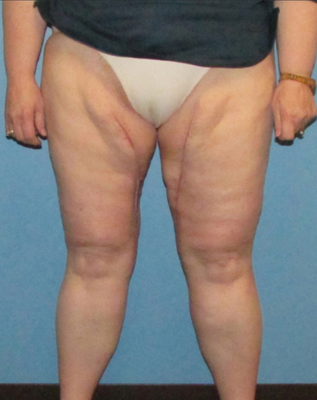 Thigh Lift After Patient 1