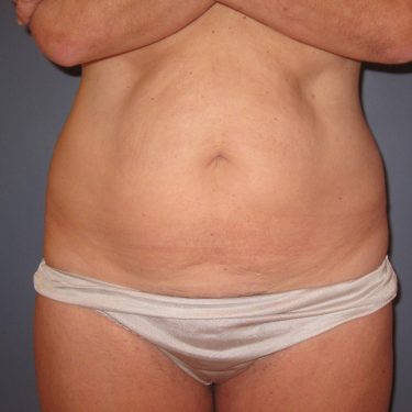 Tummy Tuck Before Patient 26