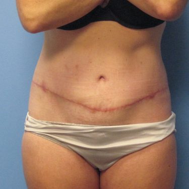 Tummy Tuck After Patient 26