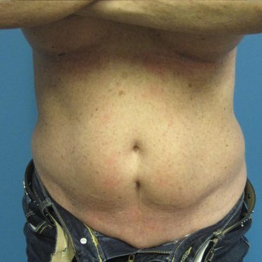 Tummy Tuck Before Patient 25