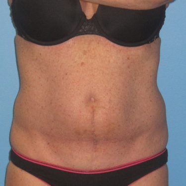 Tummy Tuck After Patient 25