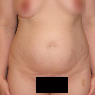 Tummy Tuck Before Patient 24