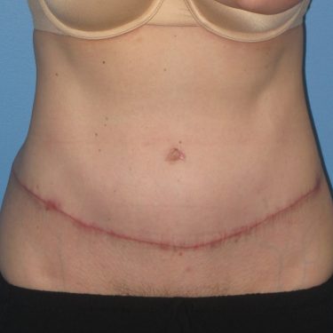 Tummy Tuck After Patient 24