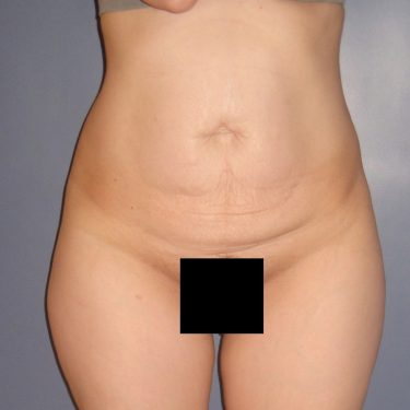 Tummy Tuck Before Patient 22