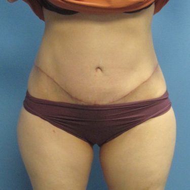 Tummy Tuck After Patient 22