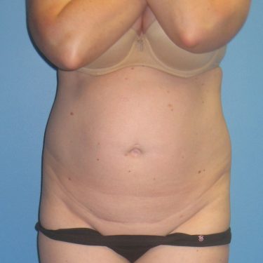 Tummy Tuck Before Patient 21