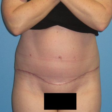 Tummy Tuck After Patient 21