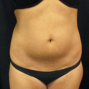 Tummy Tuck Before Patient 20