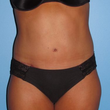 Tummy Tuck After Patient 20