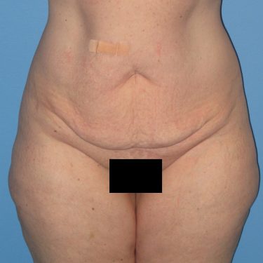 Tummy Tuck Before Patient 24