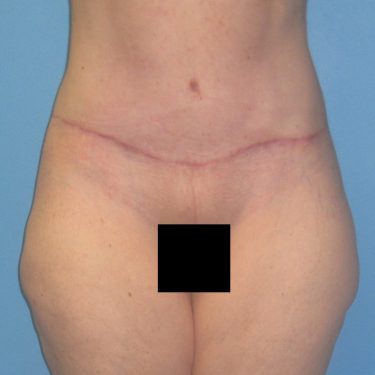 Tummy Tuck After Patient 24