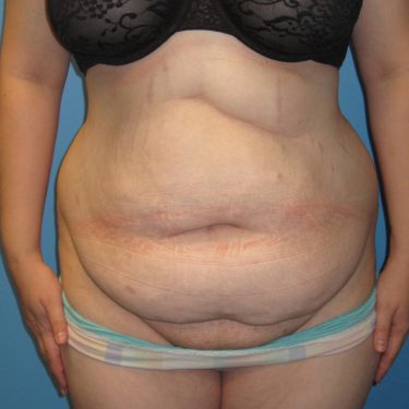 Tummy Tuck Before Patient 18