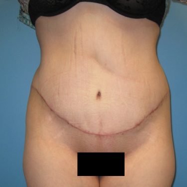 Tummy Tuck After Patient 18