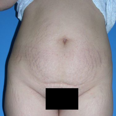 Tummy Tuck Before Patient 17