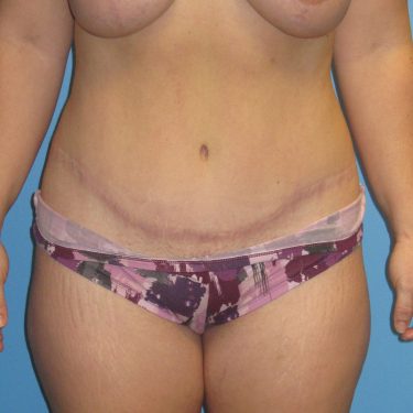 Tummy Tuck After Patient 17