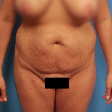 Tummy Tuck Before Patient 15