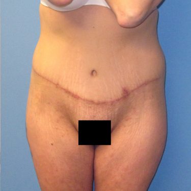 Tummy Tuck After Patient 15
