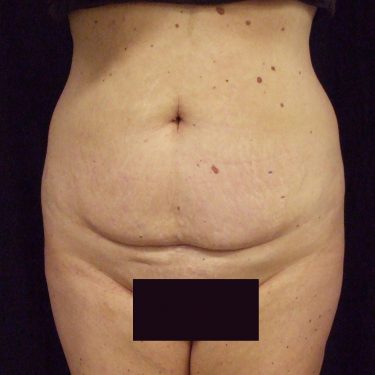 Tummy Tuck Before Patient 14
