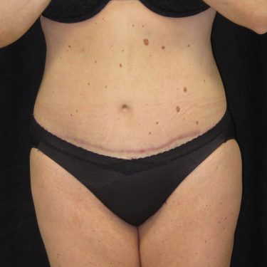 Tummy Tuck After Patient 14