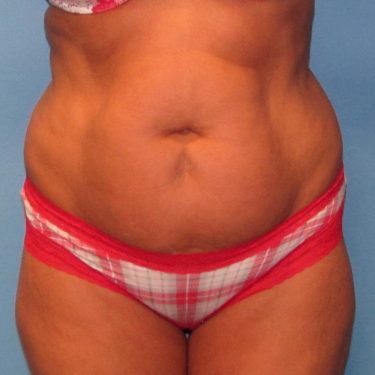 Tummy Tuck Before Patient 23