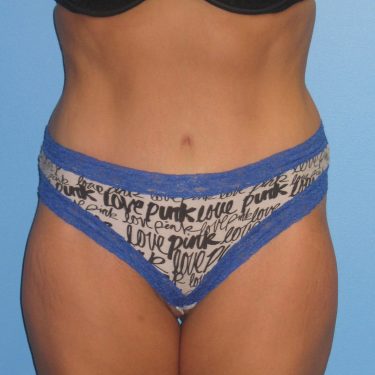 Tummy Tuck After Patient 23