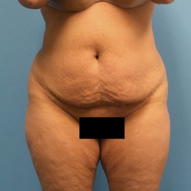 Tummy Tuck Before Patient 13