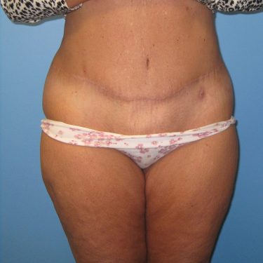 Tummy Tuck After Patient 13