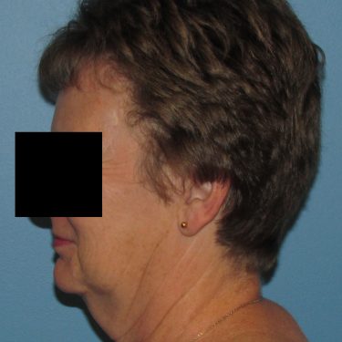 Facelift Before Patient 3