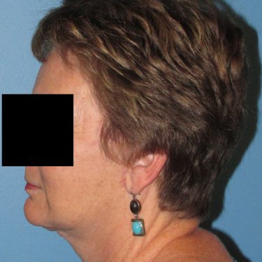 Facelift After Patient 3