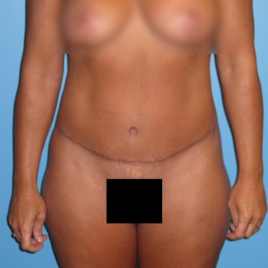 Tummy Tuck After Patient 12