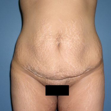 Tummy Tuck Before Patient 11