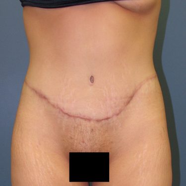 Tummy Tuck After Patient 11