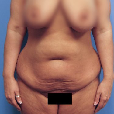 Tummy Tuck Before Patient 9