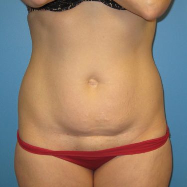 Tummy Tuck Before Patient 7