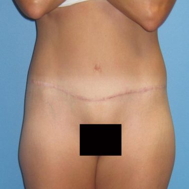 Tummy Tuck After Patient 7