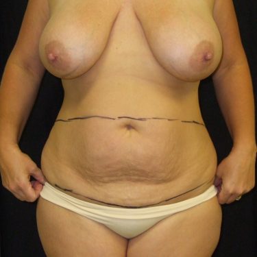 Tummy Tuck Before Patient 6